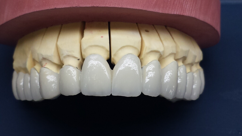 Recondent.ro - Tehnica Dentara Timisoara - Restaurari Protetice Fixe