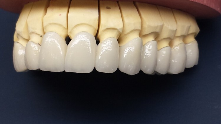 Recondent.ro - Tehnica Dentara Timisoara - Restaurari Protetice Fixe