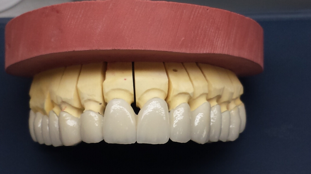 Recondent.ro - Tehnica Dentara Timisoara - Restaurari Protetice Fixe