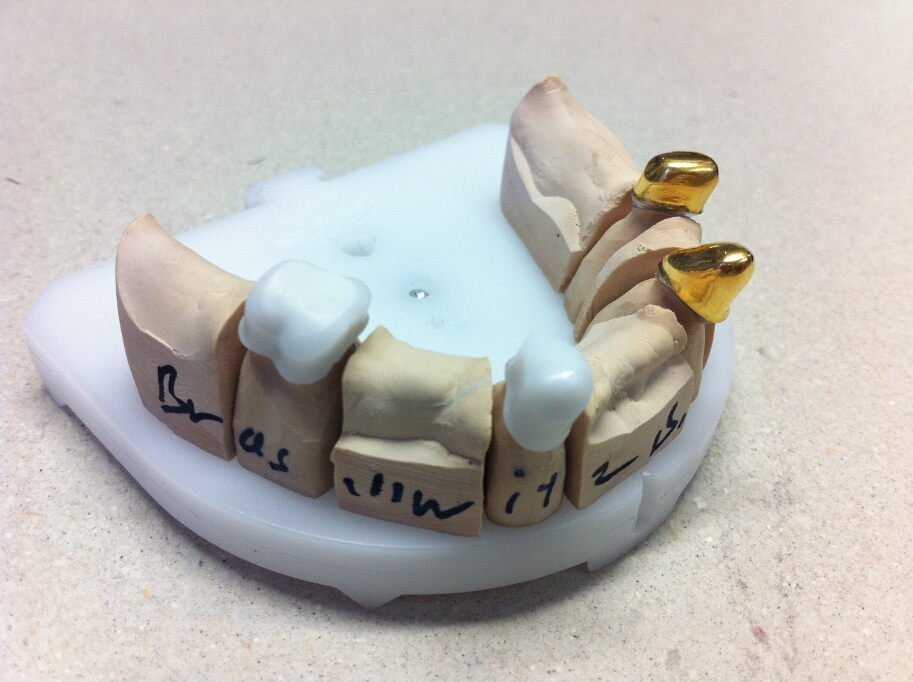 Recondent.ro - Tehnica Dentara Timisoara - Restaurari Protetice Mobilizabile