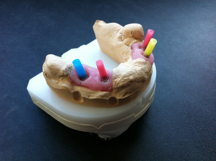 Recondent.ro - Tehnica Dentara Timisoara - Restaurari Protetice pe Implanturi