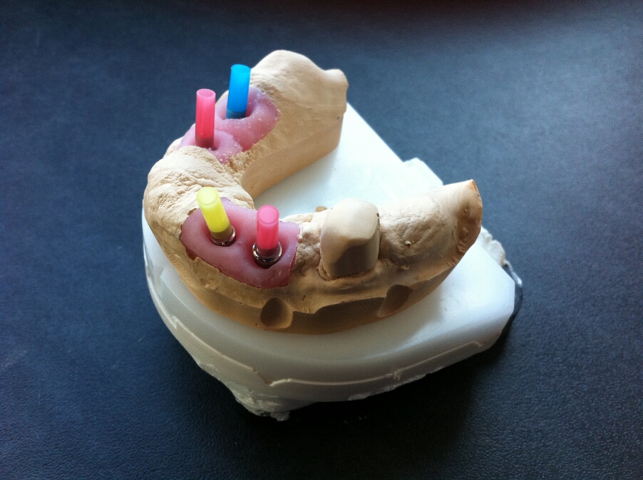 Recondent.ro - Tehnica Dentara Timisoara - Restaurari Protetice pe Implanturi