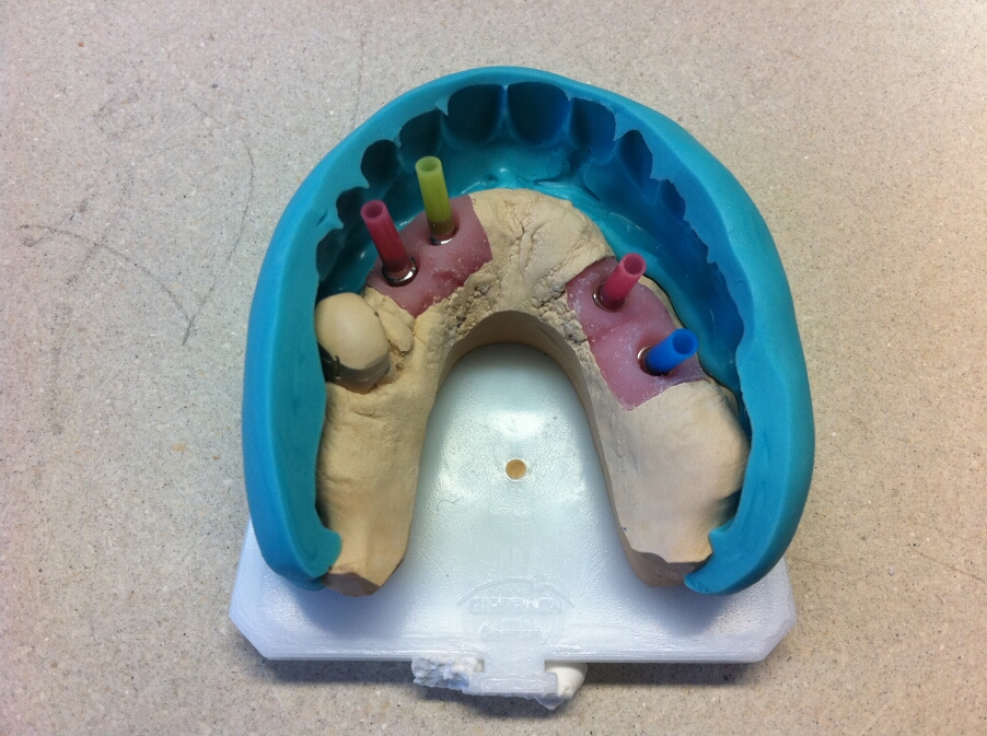 Recondent.ro - Tehnica Dentara Timisoara - Restaurari Protetice pe Implanturi