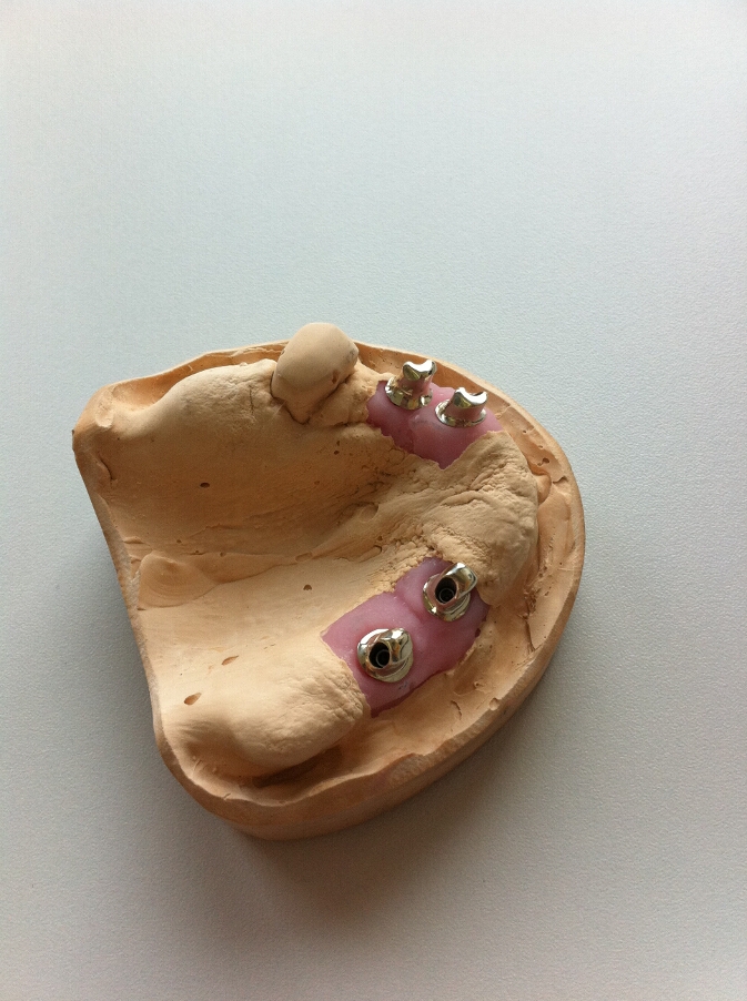 Recondent.ro - Tehnica Dentara Timisoara - Restaurari Protetice pe Implanturi