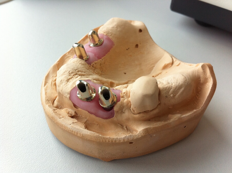 Recondent.ro - Tehnica Dentara Timisoara - Restaurari Protetice pe Implanturi