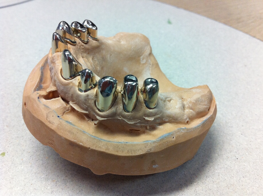 Recondent.ro - Tehnica Dentara Timisoara - Restaurari Protetice Mobilizabile