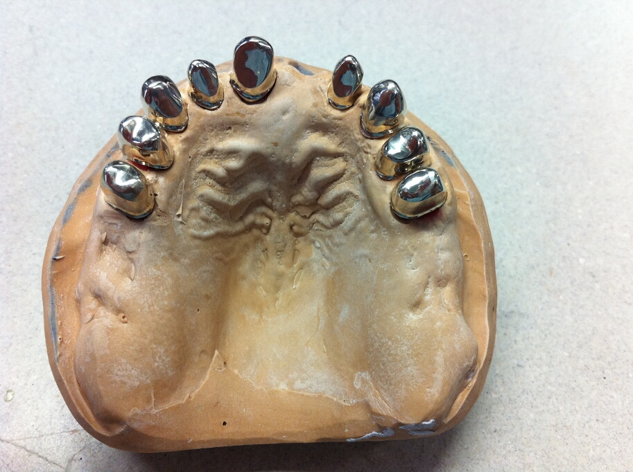 Recondent.ro - Tehnica Dentara Timisoara - Restaurari Protetice Mobilizabile