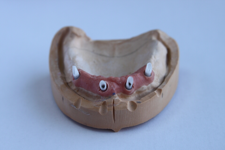 Recondent.ro - Tehnica Dentara Timisoara - Restaurari Protetice pe Implanturi