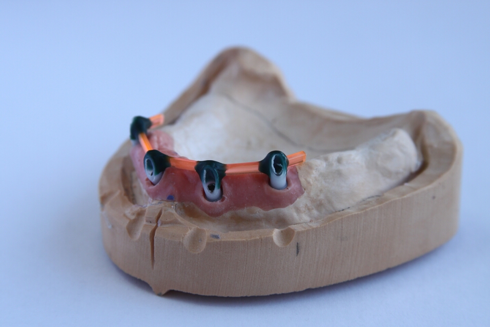 Recondent.ro - Tehnica Dentara Timisoara - Restaurari Protetice pe Implanturi