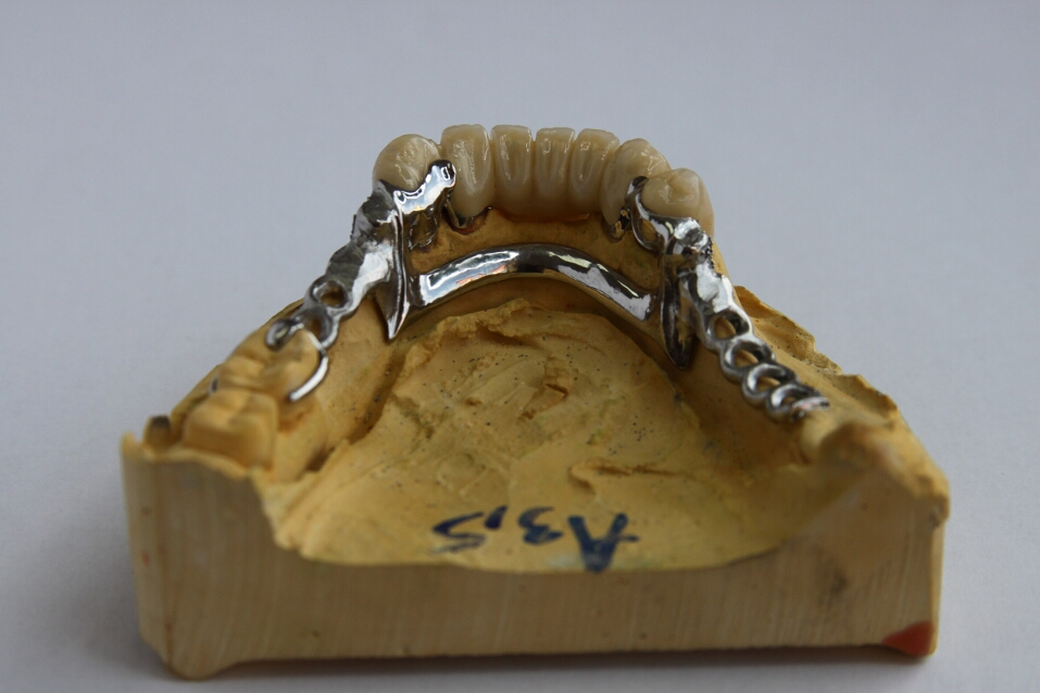 Recondent.ro - Tehnica Dentara Timisoara - Restaurari Protetice Mobilizabile