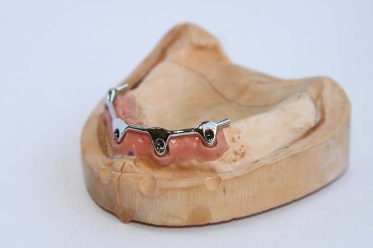 Recondent.ro - Tehnica Dentara Timisoara - Restaurari Protetice pe Implanturi