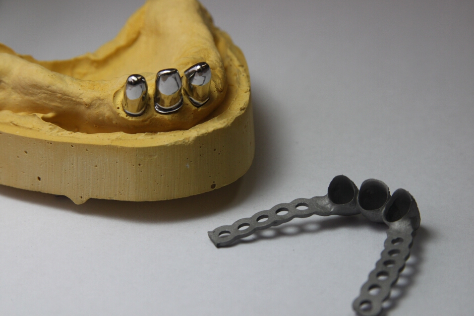 Recondent.ro - Tehnica Dentara Timisoara - Restaurari Protetice pe Implanturi