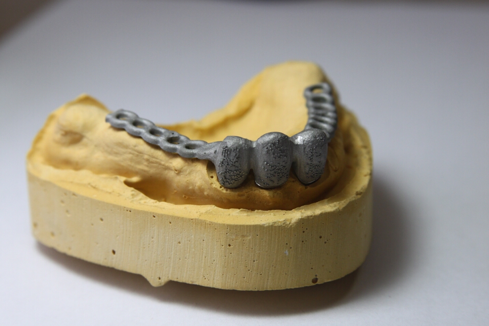 Recondent.ro - Tehnica Dentara Timisoara - Restaurari Protetice pe Implanturi