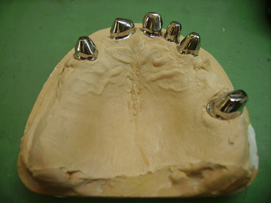 Recondent.ro - Tehnica Dentara Timisoara - Restaurari Protetice pe Implanturi