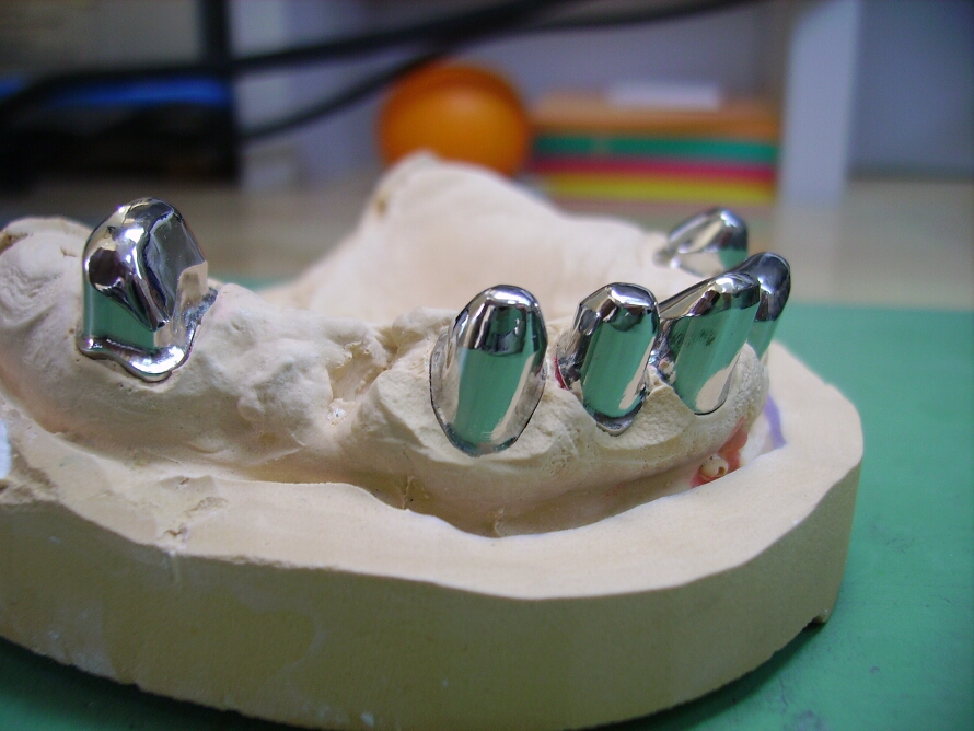 Recondent.ro - Tehnica Dentara Timisoara - Restaurari Protetice pe Implanturi