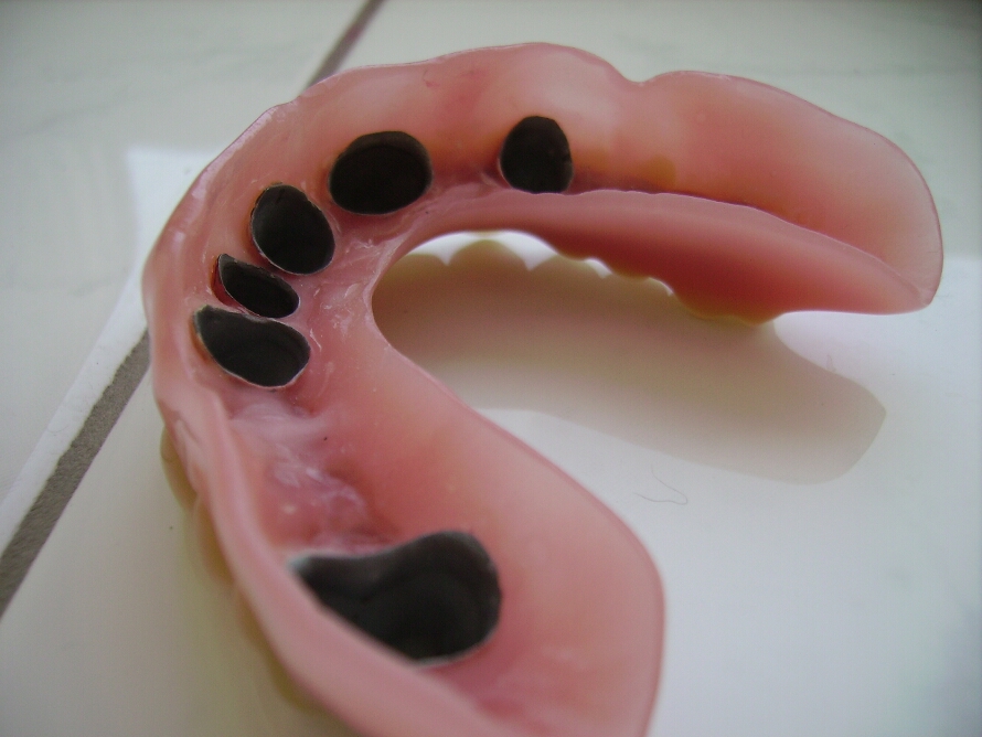 Recondent.ro - Tehnica Dentara Timisoara - Restaurari Protetice pe Implanturi