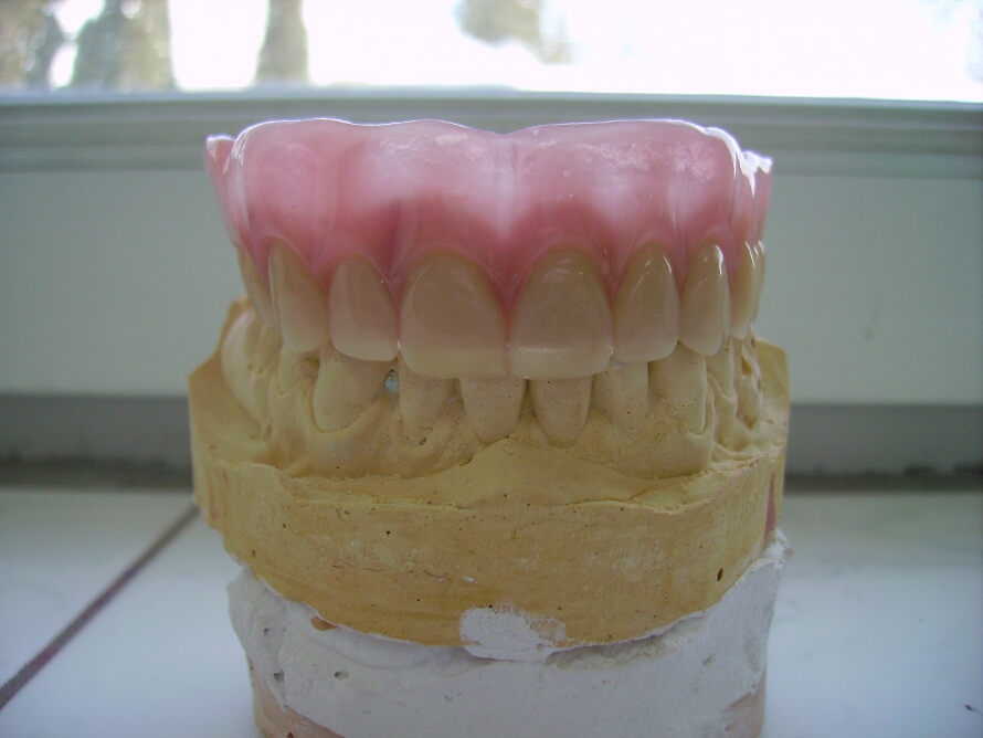 Recondent.ro - Tehnica Dentara Timisoara - Restaurari Protetice pe Implanturi