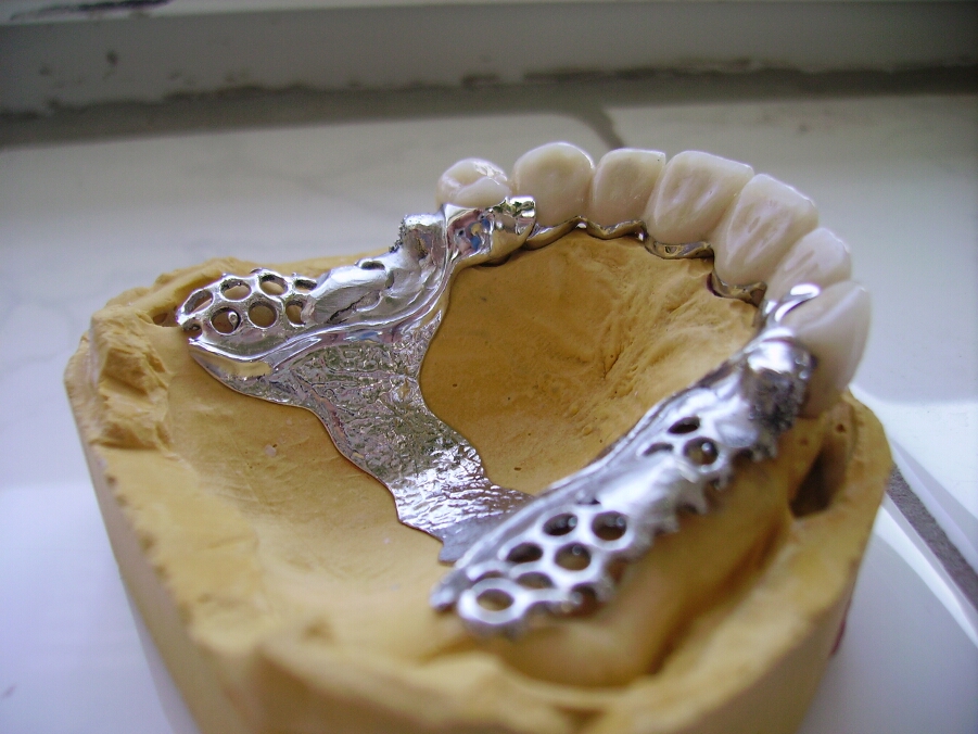 Recondent.ro - Tehnica Dentara Timisoara - Restaurari Protetice Mobilizabile