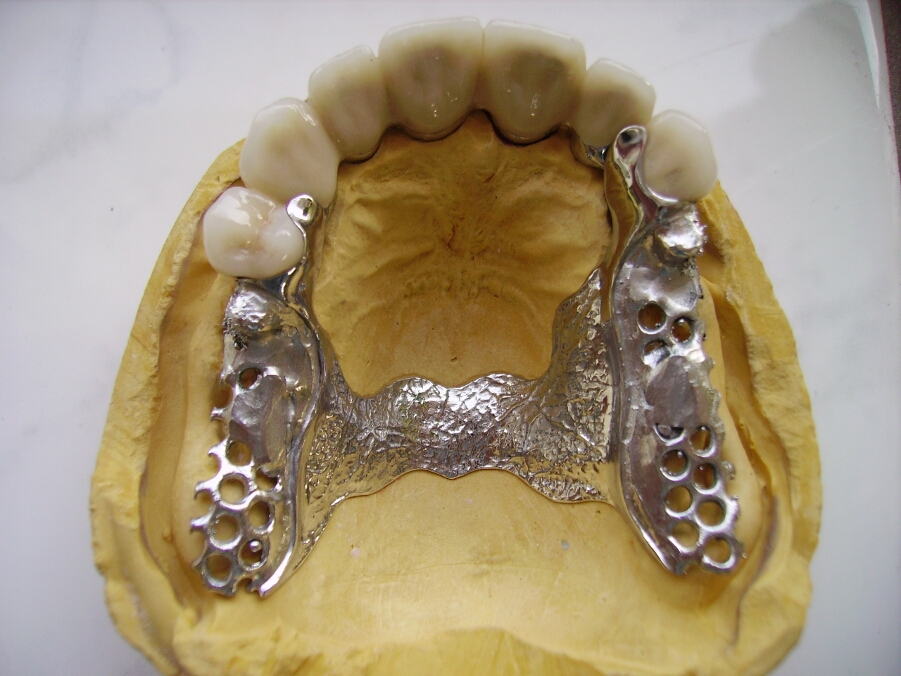 Recondent.ro - Tehnica Dentara Timisoara - Restaurari Protetice Mobilizabile