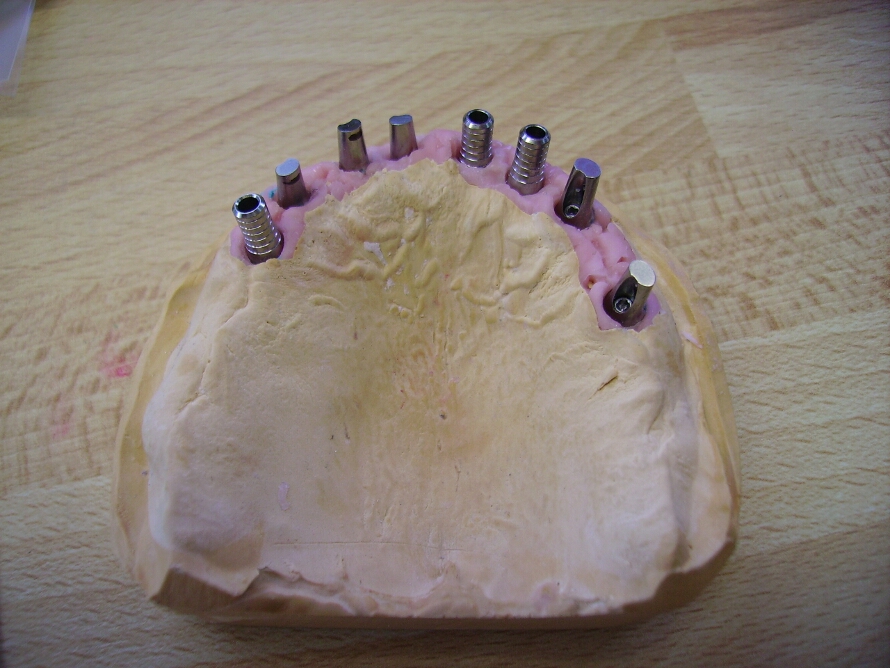 Recondent.ro - Tehnica Dentara Timisoara - Restaurari Protetice pe Implanturi