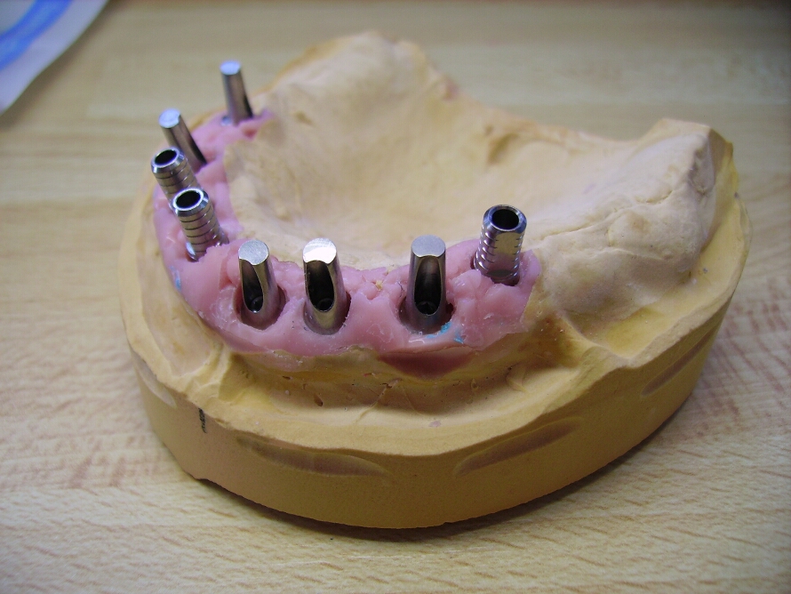Recondent.ro - Tehnica Dentara Timisoara - Restaurari Protetice pe Implanturi