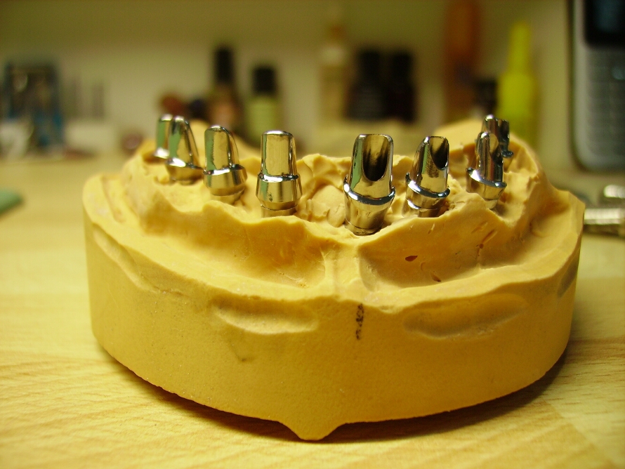 Recondent.ro - Tehnica Dentara Timisoara - Restaurari Protetice pe Implanturi