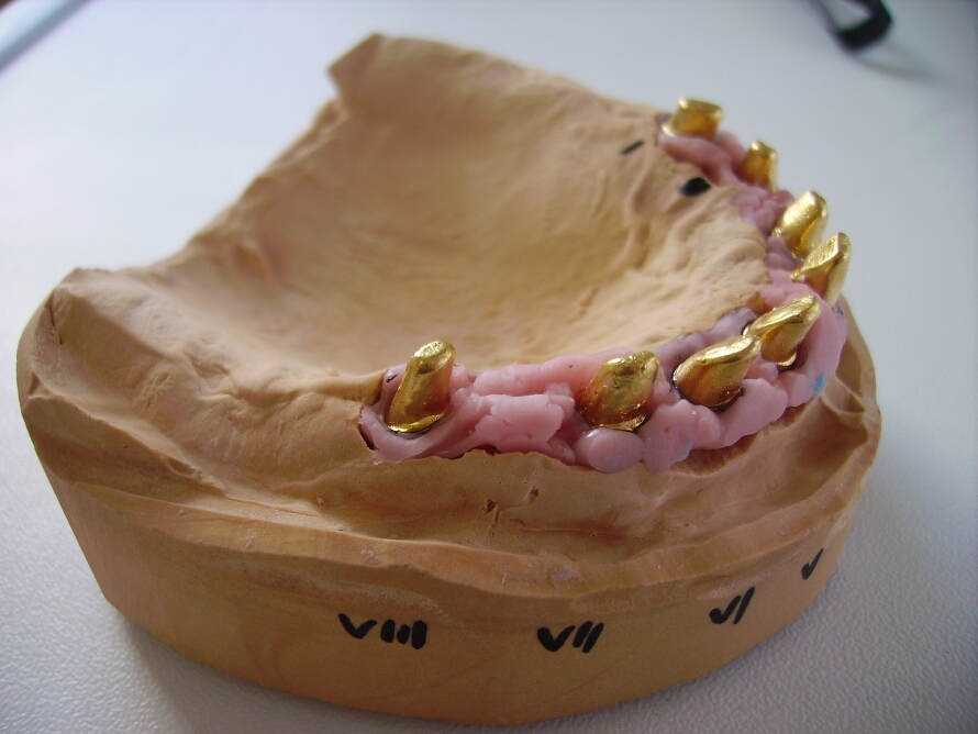 Recondent.ro - Tehnica Dentara Timisoara - Restaurari Protetice pe Implanturi