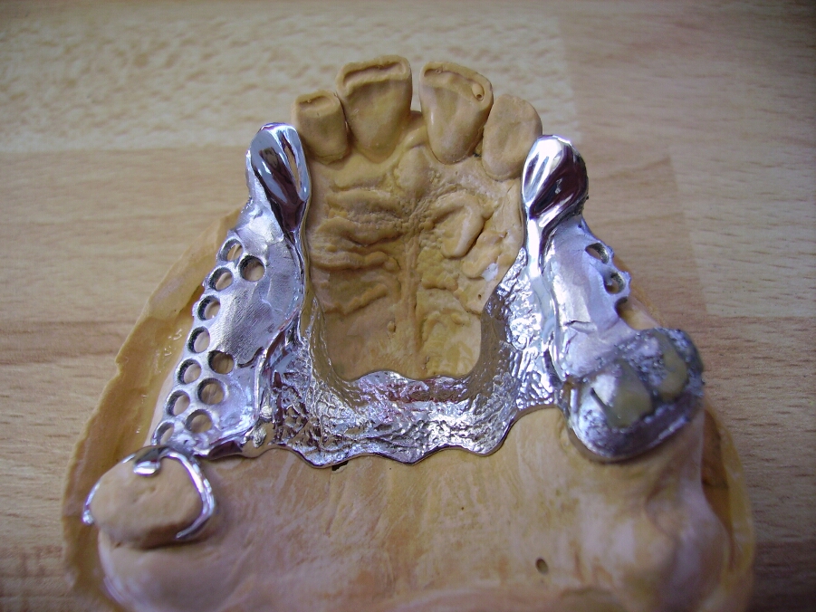 Recondent.ro - Tehnica Dentara Timisoara - Restaurari Protetice Mobilizabile